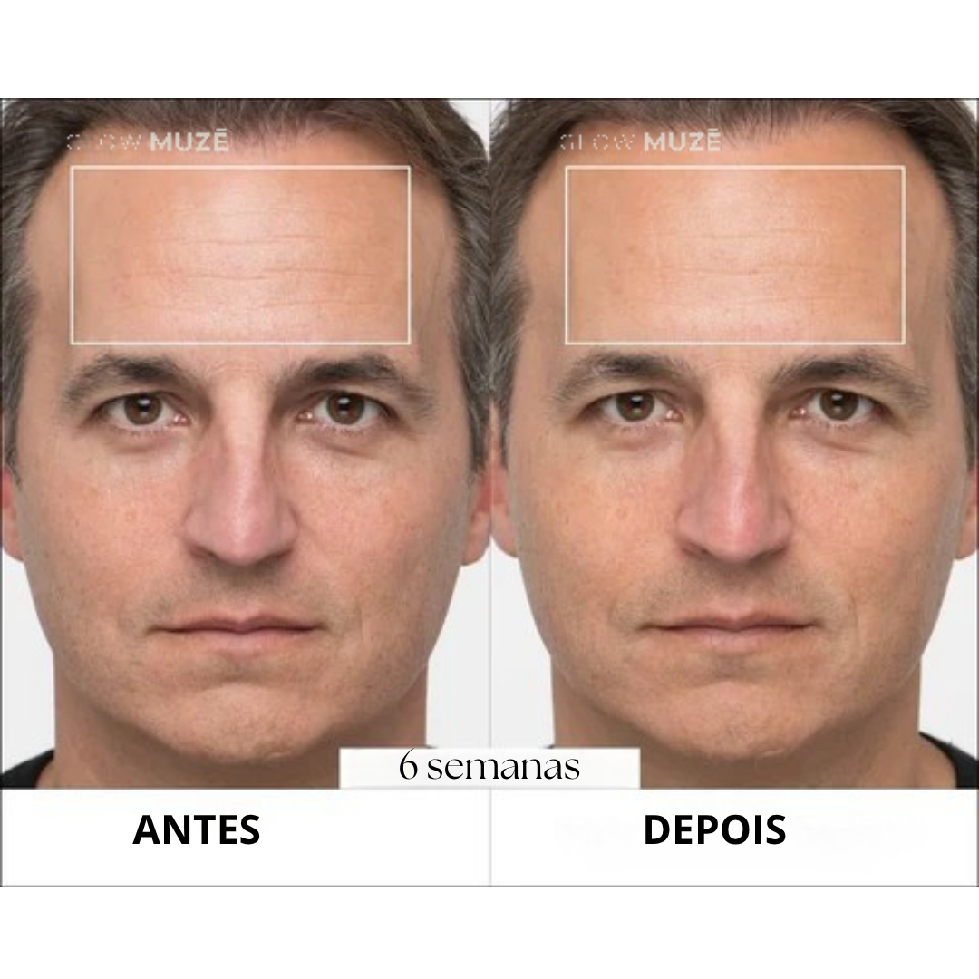 Antes e depois — 6 semanas de uso