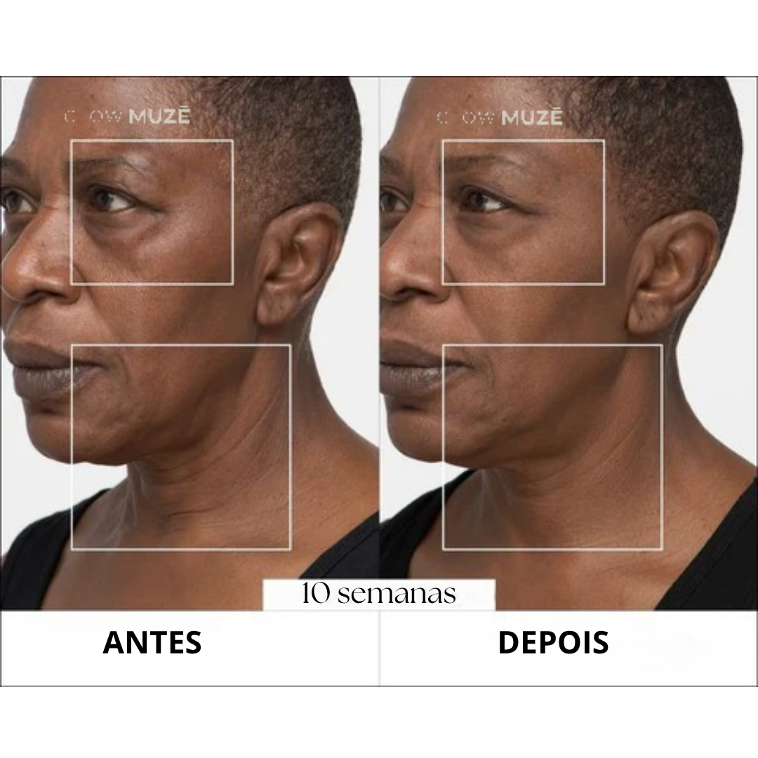 Antes e depois — 10 semanas de uso