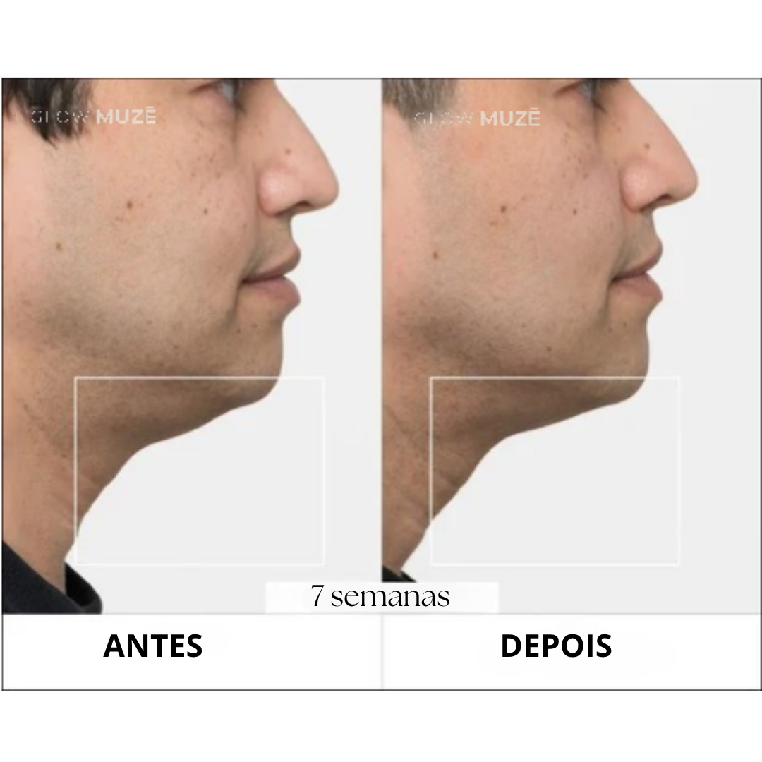 Antes e depois — 7 semanas de uso